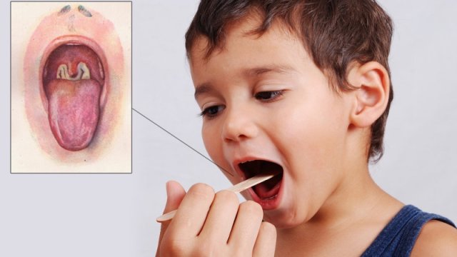 Дифтерія небезпечніша за кір: чому необхідно вакцинуватися від дифтерії та правця