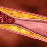 Чому треба перевіряти рівень холестерину і де це зробити безоплатно