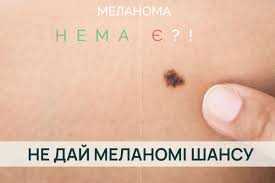 Меланома: що важливо знати кожному