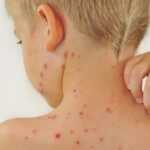 Вітрянка: що потрібно знати?